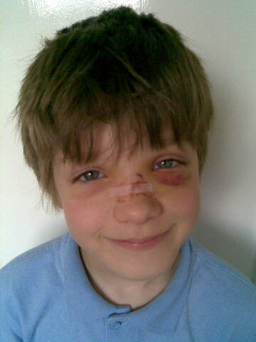 Day4, hairline fracture n still bleedy