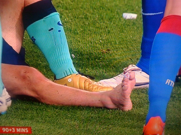 El tobillo de Messi después de la brutal entrada de Ujfalusi. Tremendo...