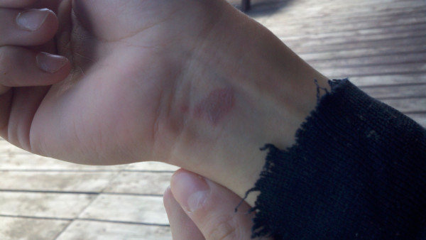 Danni's war wounds from being balls deep weeded in Canadians last night.