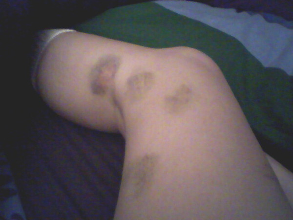 I am either a cage fighter or clumsy.