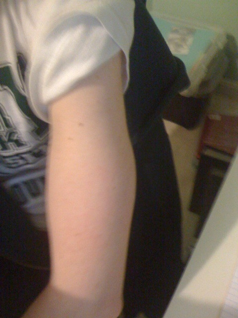 My arm is swollen from my allergy shot.